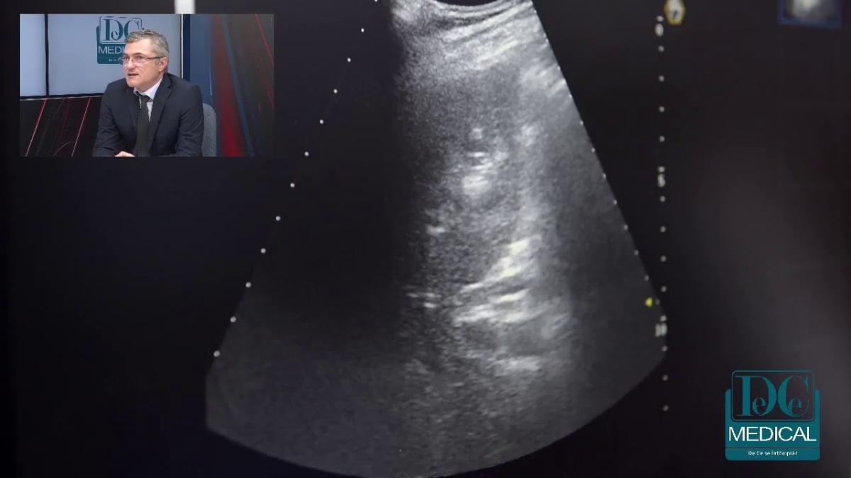Dr. Mugur Grasu: distructia cu laser a tumorilor hepatice, la Academia de Sanatate