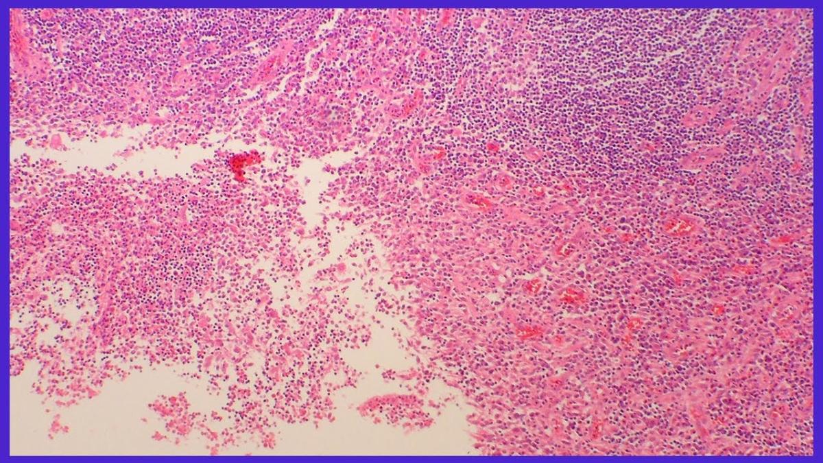 noutati in tratarea apendicitei dr balanescu explica de ce nu mai sunt spitalele pline de copii operati