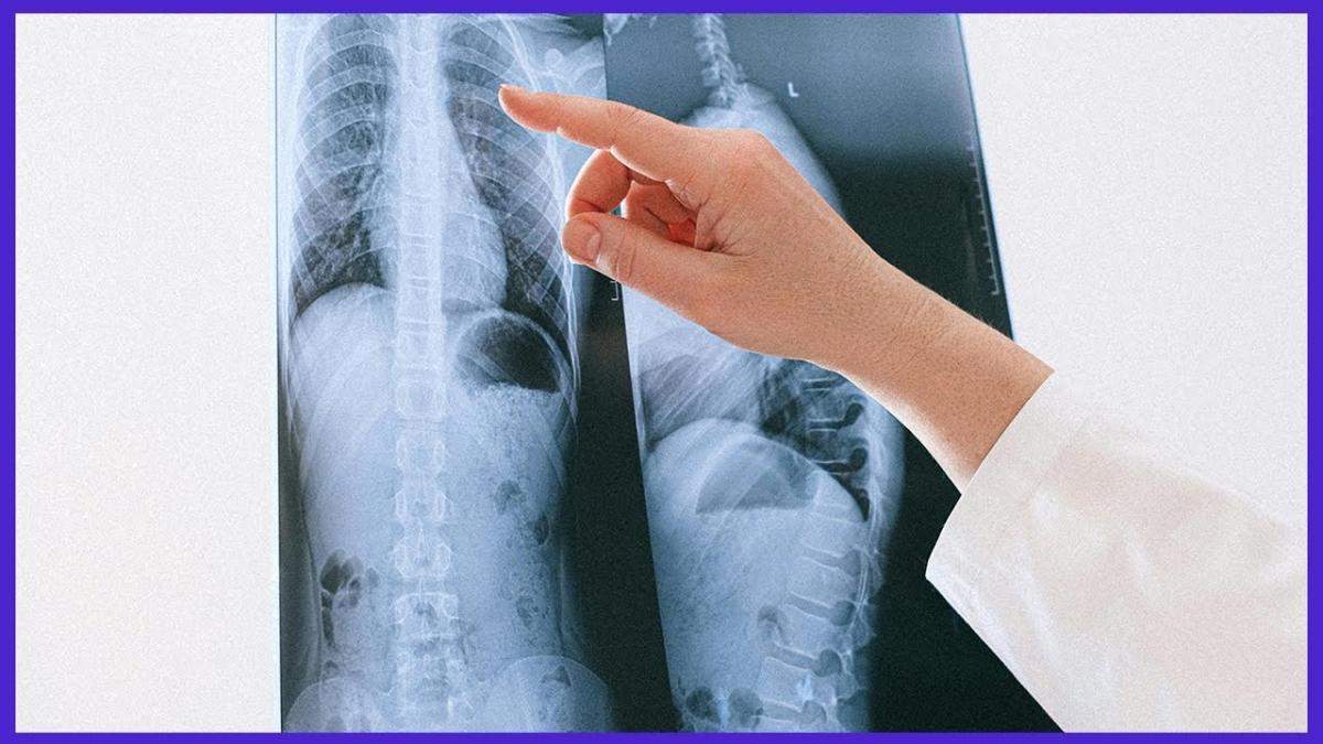 Rata cancerului bronhopulmonar la femei, în creștere. Explicația specialistului: În aceste țări se întâmplă