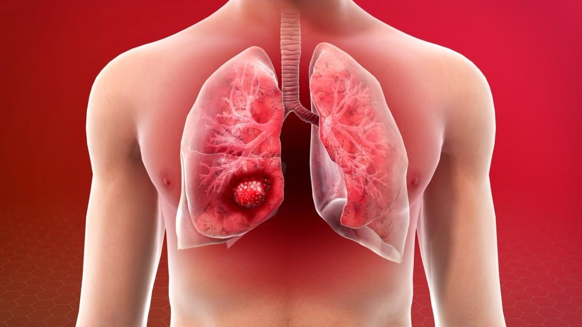Cancerul bronhopulmonar: Ce este și cum poate fi depistat precoce? Numărul cazurilor identificate anual în România