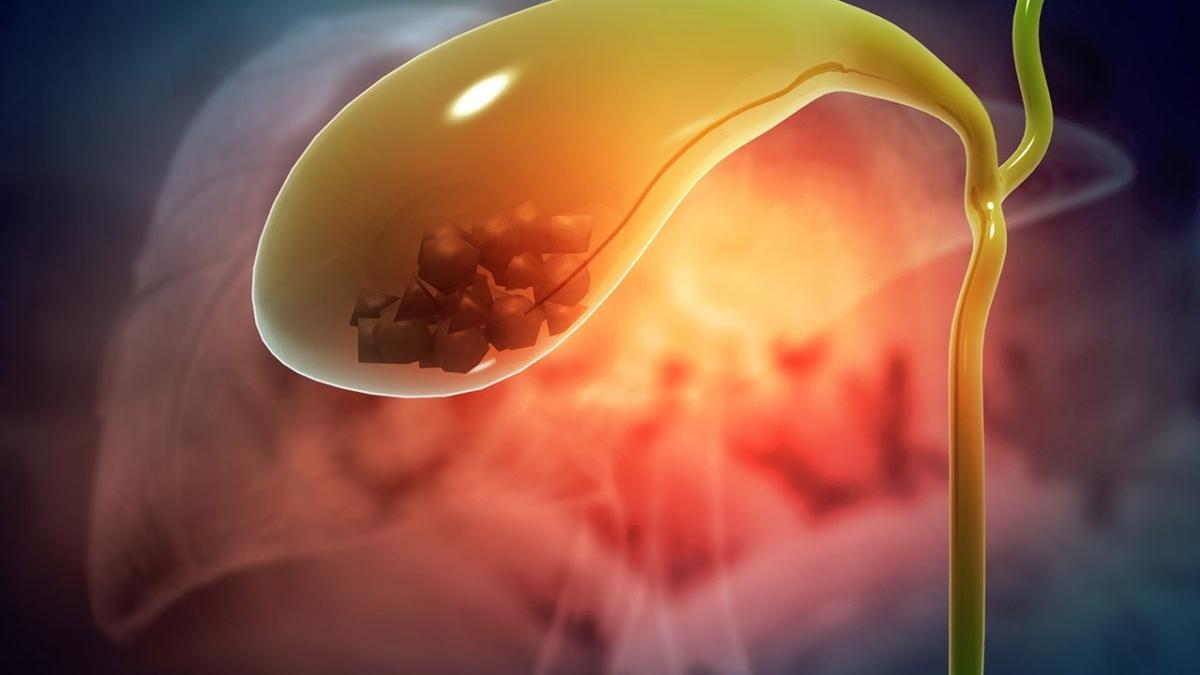 Calculii biliari sau „pietrele la fiere”, complicații. Medic: După 15 ani, riscul de a face cancer de vezică biliară e mare