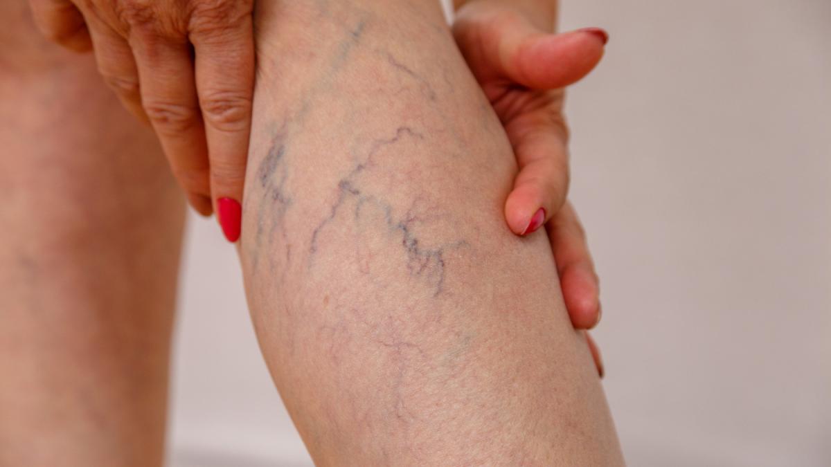 Ce putem face pentru prevenirea varicelor. Sfaturile unui medic specialist