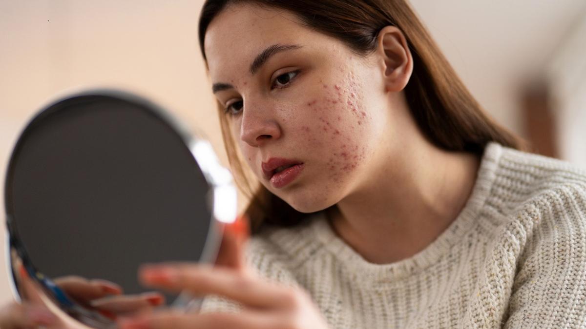 Tratezi acneea la cosmetică? Greșeală uriașă, avertizează un expert dermatolog