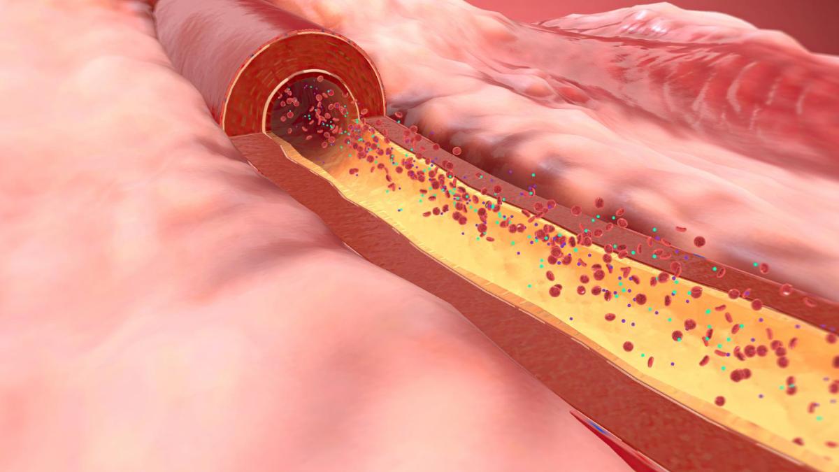 Colesterolul, mai periculos pentru tineri decât pentru vârstnici. Un medic specialist explică care sunt scenariile