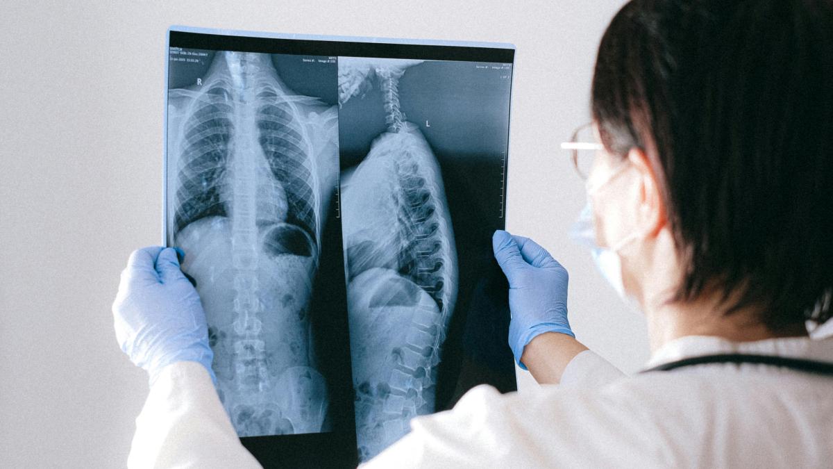 De ce se îngraşă cel mai des ficatul. Stilul de viaţă modern, una dintre cauze 